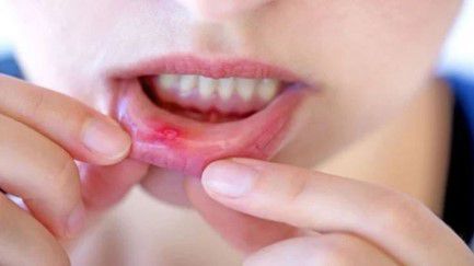Cara Pakai Cazetin Drop Untuk Sariawan Agar Khasiatnya Optimal